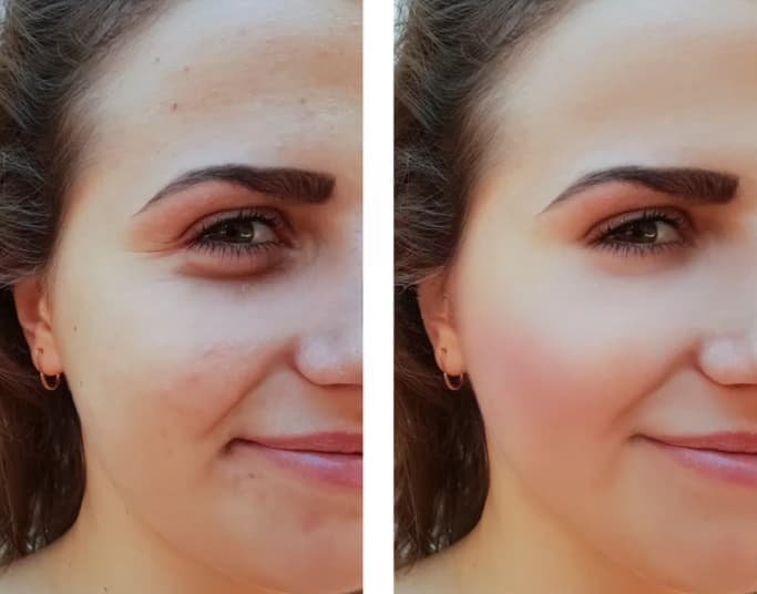 Smoother texture, less redness